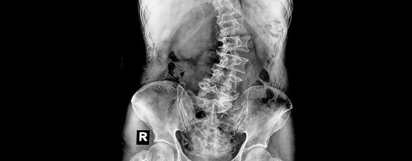 Patient suffering from Scoliosis in need of chiropractor in Cumming