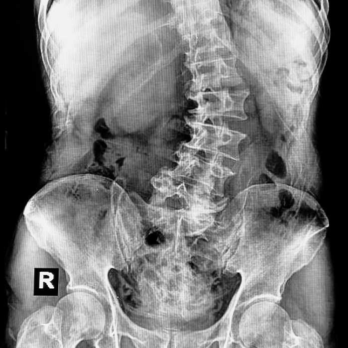 Scoliosis chiropractor in Cumming